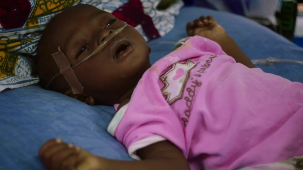 Children Under Five Dying of Malaria